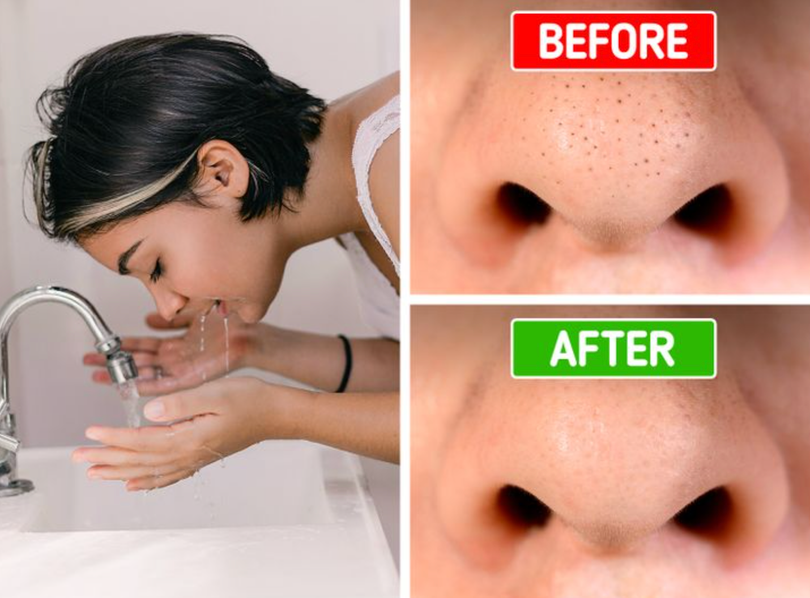 Mụn đầu đen ở lỗ chân lông được loại bỏ sau khi rửa mặt ít nhất 60 giây (Ảnh: Brightside)