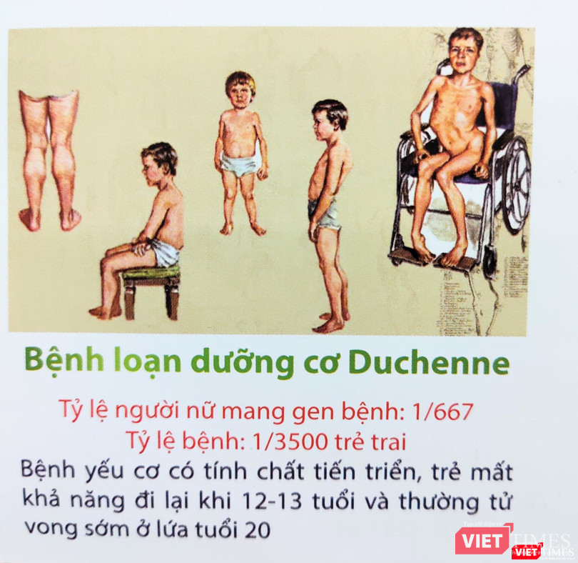 Bệnh loạn dưỡng cơ Duchenne (Ảnh: Minh Thuý)