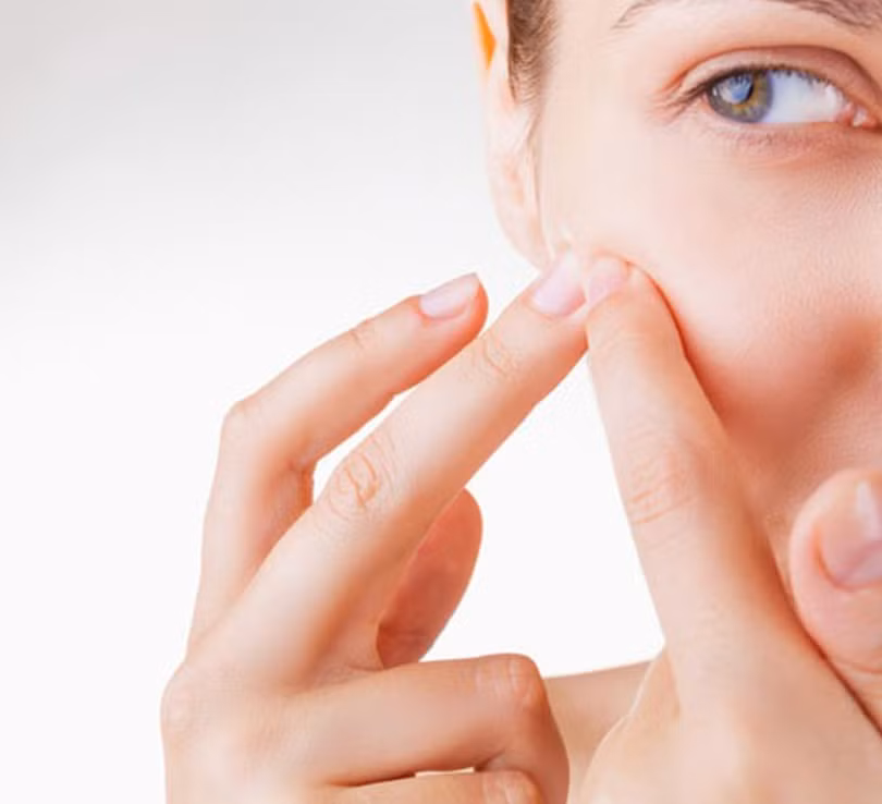 Tự nặn mụn sẽ làm tình trạng mụn trở nên trầm trọng (Ảnh: Boldsky) Tự nặn mụn sẽ làm tình trạng mụn trở nên trầm trọng (Ảnh: Boldsky)