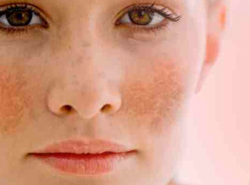 Nám da (Ảnh: Boldsky)