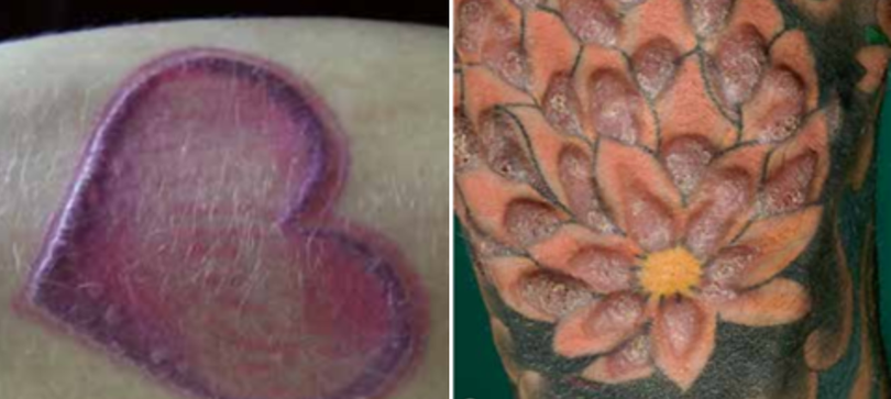 Các sần, mảng sần, sẹo lồi tồn tại dai dẳng do phản ứng dị ứng với mực xăm (Ảnh: BVCC) Các sần, mảng sần, sẹo lồi tồn tại dai dẳng do phản ứng dị ứng với mực xăm (Ảnh: BVCC)