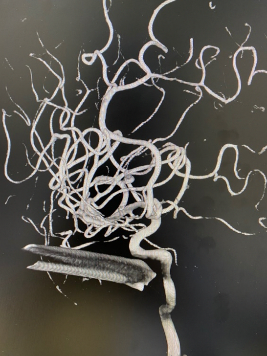 Hình ảnh thanh sắt đâm vào mặt bệnh nhân (Ảnh - BVCC)