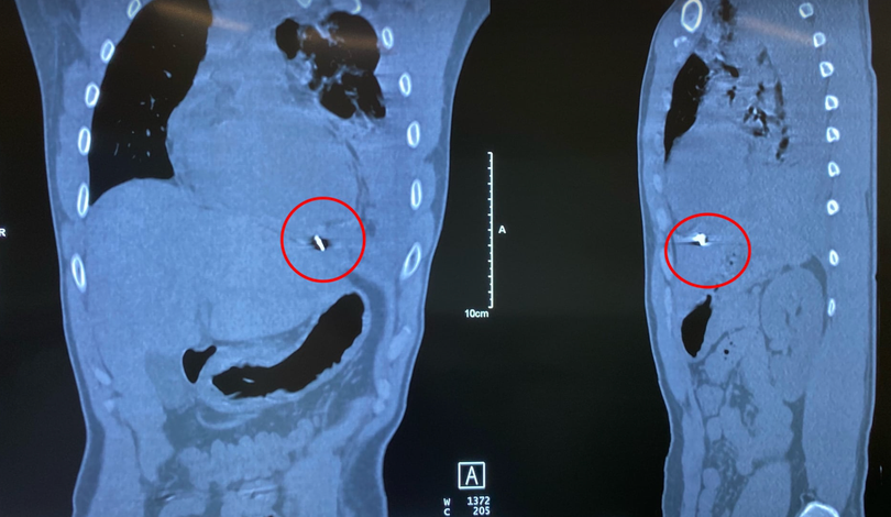 Hình ảnh dị vật găm trong ngực trái bệnh nhân (Ảnh - BVCC)