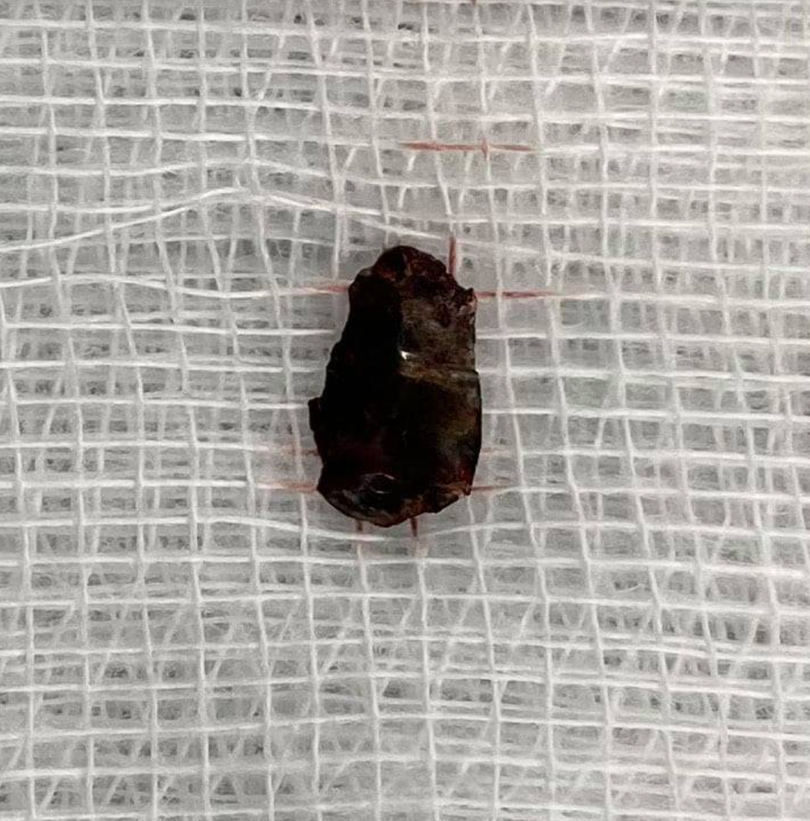 Dị vật kim khí được lấy ra từ ngực trái của bệnh nhân (Ảnh - BVCC)