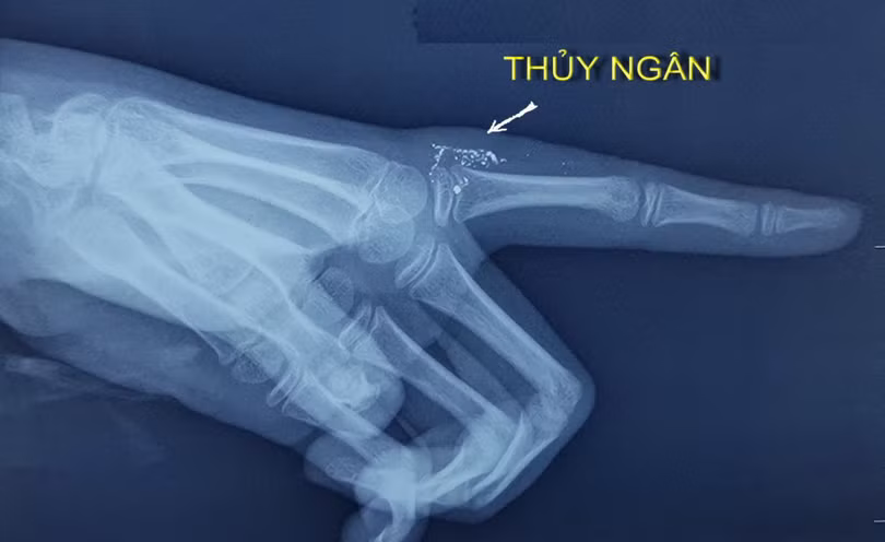 Ảnh chụp X-quang tay bé gái bị nhiễm độc thuỷ ngân (Ảnh BVCC) Ảnh chụp X-quang tay bé gái bị nhiễm độc thuỷ ngân (Ảnh BVCC)