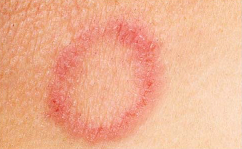 Hình ảnh bệnh giang mai (Ảnh - BVCC)