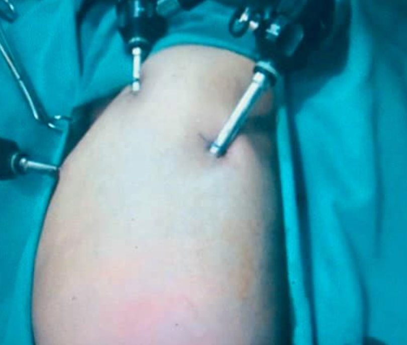 Các bác sĩ phẫu thuật nội soi cho bệnh nhi (Ảnh - BVCC)