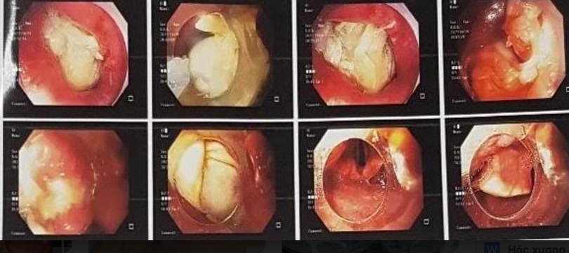Hình ảnh xương gà mắc trong cổ họng bệnh nhân (Ảnh - BVCC) 