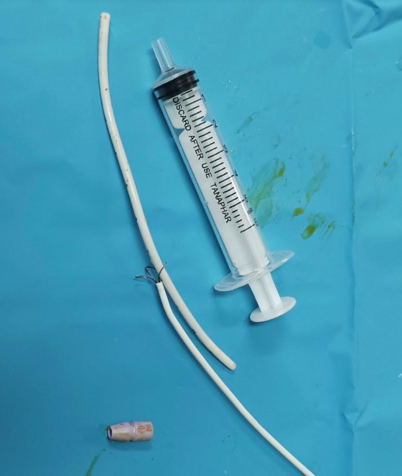 Hình ảnh dị vật kẹt trong tim bệnh nhân (Ảnh - BVCC)