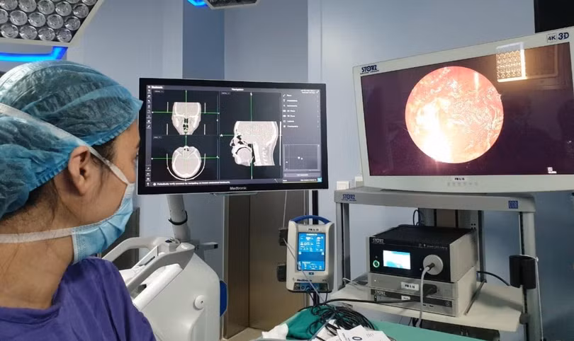 Các bác sĩ của Bệnh viện Trung ương Quân đội 108 phẫu thuật loại bỏ khối u cho bệnh nhân (Ảnh - BVCC) 