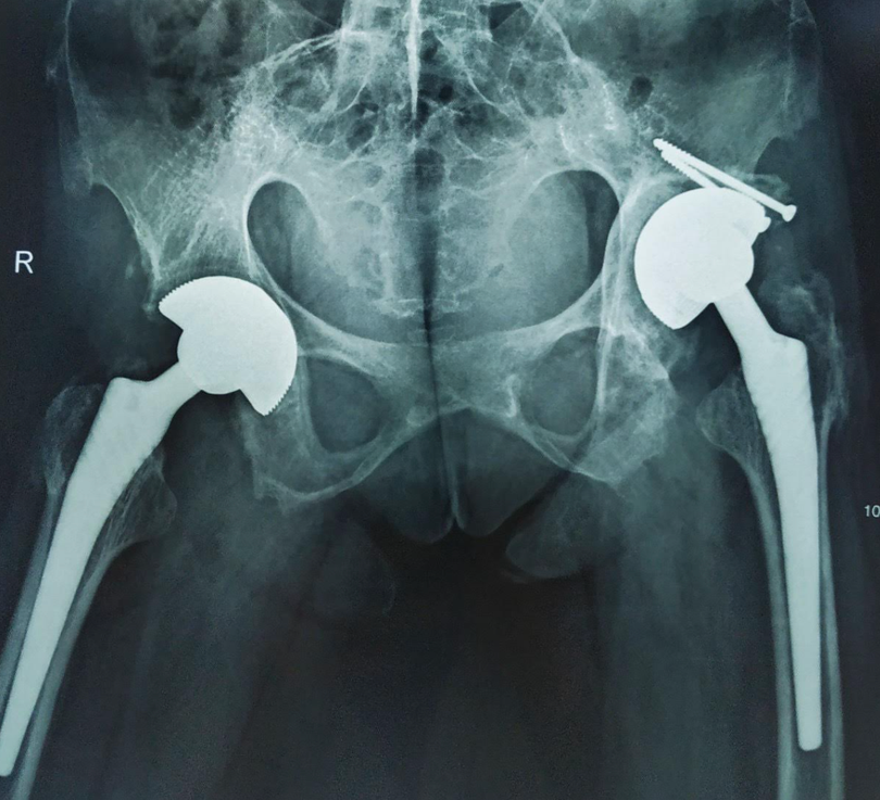 Hình ảnh X-quang khớp háng của bệnh nhân (Ảnh - BVCC)