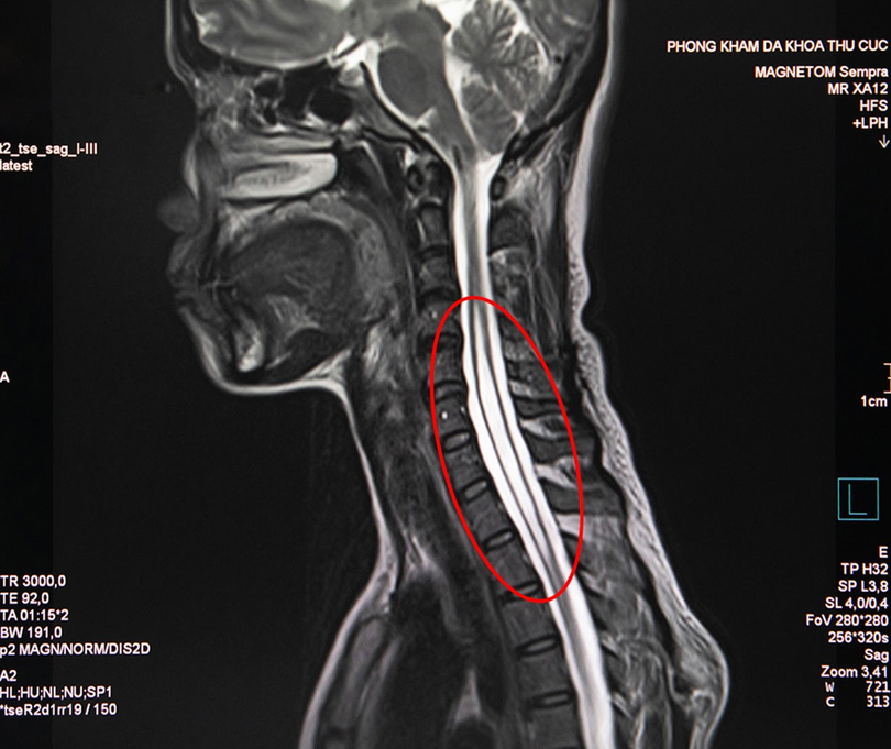 Hình ảnh tuỷ sống của bệnh nhân (Ảnh - PKCC)