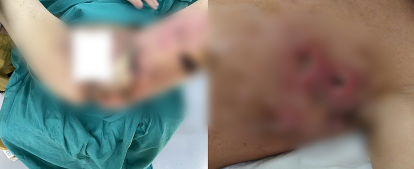 Hình ảnh nhiễm trùng hoại tử da của 2 bệnh nhân (Ảnh - BVCC)