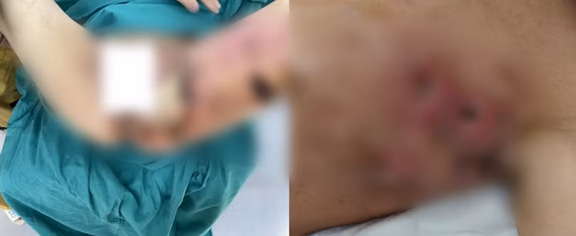 Hình ảnh nhiễm trùng hoại tử da của 2 bệnh nhân (Ảnh - BVCC)