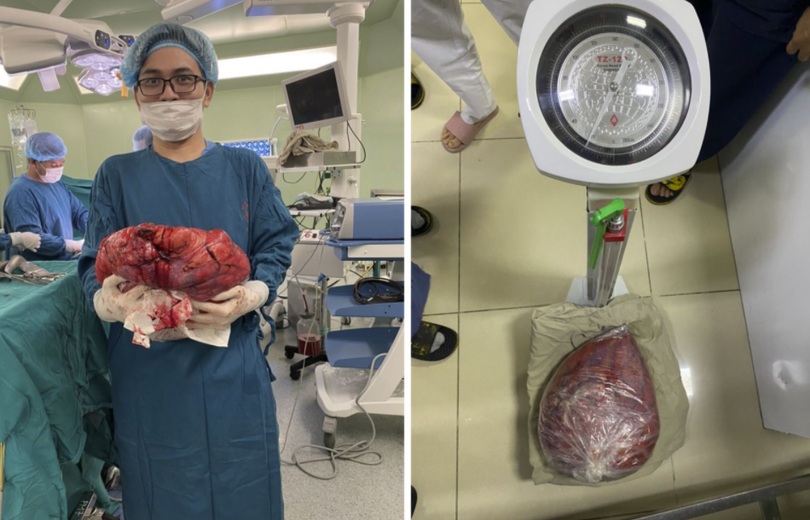 Khối u nặng 10kg của bệnh nhân (Ảnh - BVCC)