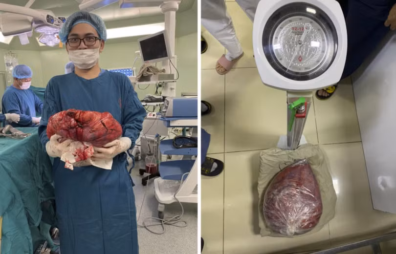 Khối u nặng 10kg của bệnh nhân (Ảnh - BVCC) Khối u nặng 10kg của bệnh nhân (Ảnh - BVCC)