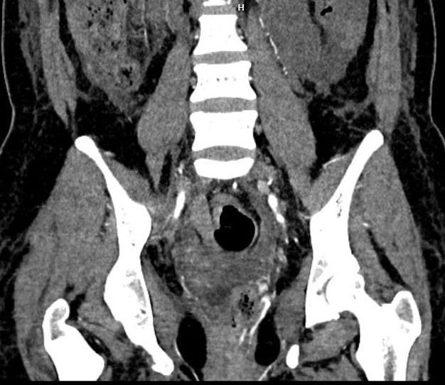 Hình ảnh thoát thuốc vị trí động mạch tử cung trái và quanh trực tràng của bệnh nhân (Ảnh - BVCC) Hình ảnh thoát thuốc vị trí động mạch tử cung trái và quanh trực tràng của bệnh nhân (Ảnh - BVCC)