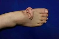 Chiếc tai đã được cấy ghép vào bàn chân của bệnh nhân trong nhiều tháng. Ảnh: QQ.