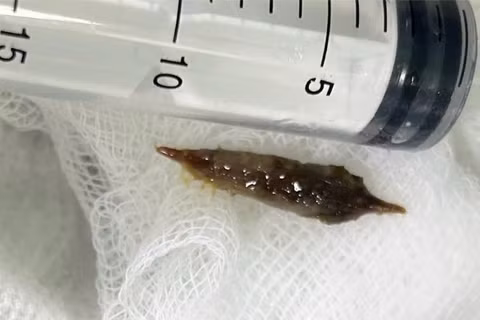 Cô gái suýt thủng dạ dày vì vô tình nuốt hạt táo đỏ, bác sĩ đưa ra khuyến cáo