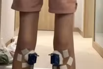 Nam sinh 16 tuổi cao thêm 1,4 cm, nhưng chỉ 2 tuần sau khi dừng trị liệu, phần tăng trưởng ấy biến mất hoàn toàn. Ảnh: OddCentral.