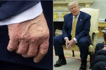Bàn tay phải của Tổng thống Mỹ Donald Trump được nhìn thấy khi ông phát biểu với báo chí trước khi lên trực thăng vào ngày 15/7 và Tổng thống trong một cuộc họp tại Phòng Bầu dục của Nhà Trắng vào ngày 16/7. Ảnh: AFP.