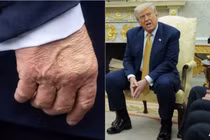 Bàn tay phải của Tổng thống Mỹ Donald Trump được nhìn thấy khi ông phát biểu với báo chí trước khi lên trực thăng vào ngày 15/7 và Tổng thống trong một cuộc họp tại Phòng Bầu dục của Nhà Trắng vào ngày 16/7. Ảnh: AFP.