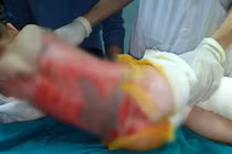 Trẻ nhỏ bị bỏng nặng đang điều trị tại Bệnh viện đa khoa tỉnh Tuyên Quang