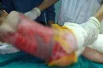 Trẻ nhỏ bị bỏng nặng đang điều trị tại Bệnh viện đa khoa tỉnh Tuyên Quang
