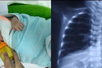 Em bé D.A bị dị dạng đường dẫn khí phổi bẩm sinh