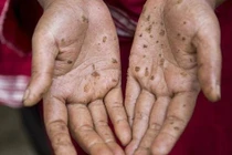 Bệnh nhân bị ung thư da do nhiễm độc Asen: Nguy cơ từ thuốc không nguồn gốc và nước giếng khoan 