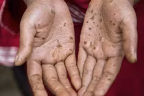 Bệnh nhân bị ung thư da do nhiễm độc Asen: Nguy cơ từ thuốc không nguồn gốc và nước giếng khoan 