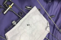 Đinh vít nằm ở đường thở của bệnh nhân nhi tên N. ở Quảng Nam sau khi nội soi gắp ra.