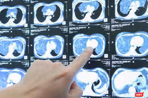 Hình ảnh khối u khổng lồ trong khoang ngực của bệnh nhân M.