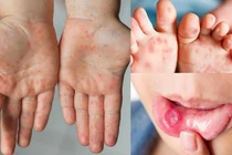 Bệnh tay chân miệng ở trẻ em (ảnh SKĐS)