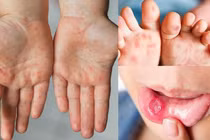 Bệnh tay chân miệng ở trẻ em (ảnh SKĐS)