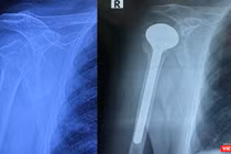 Phim chụp khớp vai của bệnh nhân trước và sau phẫu thuật