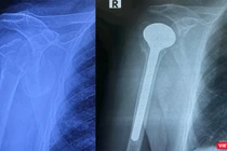 Phim chụp khớp vai của bệnh nhân trước và sau phẫu thuật