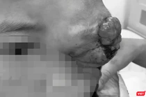 Bệnh nhân L.M.Q. (9 tuổi, dân tộc Thái, quê ở Sơn La) với khối u hốc mắt từ nhỏ trước khi phẫu thuật