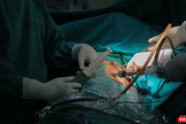 Ê-kíp bác sĩ phẫu thuật do Ths.Bs Nguyễn Văn Lâm – Khoa Ngoại tổng hợp, Bệnh viện đa khoa Đức Giang sử dụng kỹ thuật nội soi để bóc ổ cặn màng phổi nghi do di chứng COVID-19 cho bệnh nhân