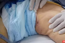 Vết loét điển hình trên vùng bẹn của bệnh nhân sốt mò - một dấu hiệu để phân biệt sốt mò và các bệnh truyền nhiễm khác (ảnh bệnh viện cung cấp)