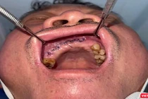 Bệnh nhân sau khi được phẫu thuật điều trị (ảnh bệnh viện cung cấp)