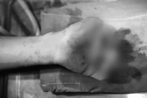 Bé T. đã mất 3 ngón tay do pin của quạt tích điện phát nổ (Ảnh: BVCC) 