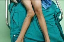 Khớp gối của thiếu niên 14 tuổi bị biến dạng (Ảnh - BVCC) 