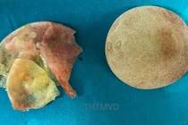 Túi ngực vỡ của chị V. được lấy ra sau 5 năm phẫu thuật nâng ngực (Ảnh - Bệnh viện Hữu nghị Việt Đức) 