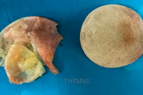 Túi ngực vỡ của chị V. được lấy ra sau 5 năm phẫu thuật nâng ngực (Ảnh - Bệnh viện Hữu nghị Việt Đức) 