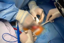 Các bác sĩ phẫu thuật cho bé (Ảnh - BVCC) 