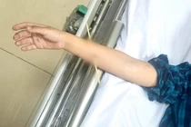 Bé trai 6 tuổi không may bị xiên tre đâm xuyên cẳng tay phải (Ảnh: BVCC)