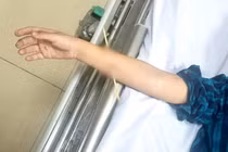 Bé trai 6 tuổi không may bị xiên tre đâm xuyên cẳng tay phải (Ảnh: BVCC)