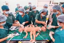 Gần 100 y, bác sĩ đang tiến hành phẫu thuật tách rời cặp song sinh Trúc Nhi – Diệu Nhi (Ảnh: Bệnh viện Nhi đồng Thành phố - TP. Hồ Chí Minh)