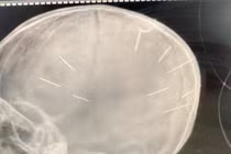 Hình ảnh chụp X-Quang hộp sọ bệnh nhân với 9 hình thể nghi là đinh (Ảnh: Bệnh viện Đa khoa huyện Thạch Thất cung cấp)